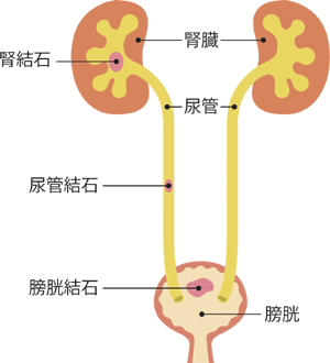 尿管結石の説明図